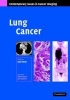 Lung Cancer (Hardcover) - Sujal R Desai Photo