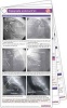 Angiography Pocketcard Set (Cards) - Anthony Bavry Photo