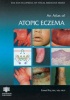 An Atlas of Atopic Eczema (Hardcover, New) - Lionel Fry Photo